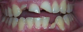 Image result for Cricket Tooth