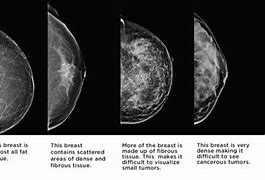 Image result for BREAST