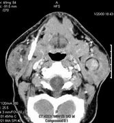 Image result for Parotid Gland Tumor