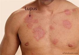Image result for Skin Lupus