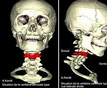 Image result for Vertebral Body MRI