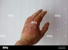 Image result for Severe Hand Burn