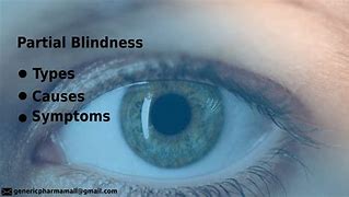 Image result for Partial Blindness