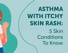 Image result for Asthma Rash