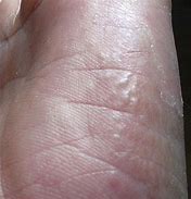 Image result for Nickel Allergy Rash From Metal