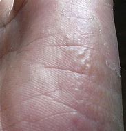 Image result for Nickel Contact Dermatitis