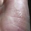 Image result for Nickel Contact Dermatitis