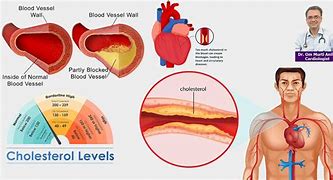 Image result for Difference Between Triglycerides and Cholesterol