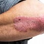 Image result for Eczema Skin Rash