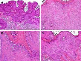 Image result for Condyloma Causes