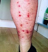 Image result for Bed Bug Bites On Stomach