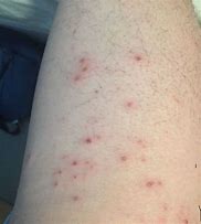 Image result for Molluscum Contagiosum Virus