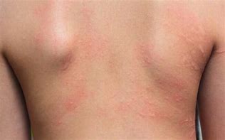 Image result for Chikungunya Erupcoes Na Pele