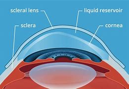 Image result for Scleral Contact Lens