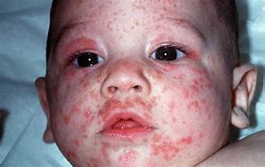 Image result for Pediatric Pustular Rash