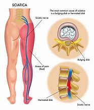 Image result for Acupuncture for Sciatica