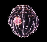 Image result for Brain Cancer Cells