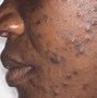 Image result for Eczema Black Skin