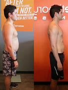 Image result for Mini Bypass Weight Loss