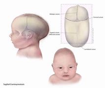 Image result for Craniosynostosis Baby Head Shapes