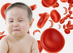 Image result for Sickle Cell Diagnosis