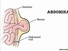 Image result for Small Intestine Hernia