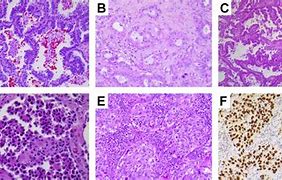 Image result for Lung Cancer Pathology