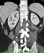 Image result for Complex Proteinaceous Cyst of Kidney