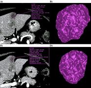 Image result for Cancer Tumor 6 mm How Big