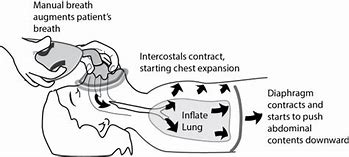 Image result for Assisted Ventilation