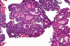 Image result for Fungiform Type of Sinonasal Papilloma