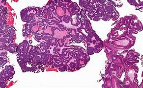 Image result for Papilloma Nose