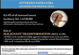 Image result for Inverted Papilloma Nose