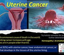 Image result for uterine cancers cause