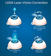 Image result for LASIK Eye Glimmer