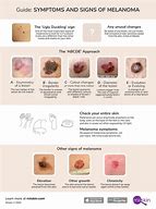 Image result for What Does Melanoma Skin Cancer Look Like