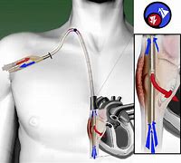 Image result for Double Lumen PICC Line