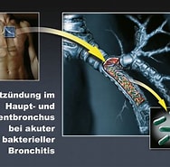 Image result for Lungenabszess durch Staphylokokken. Size: 188 x 185. Source: schwerwiegendesymptome.blogspot.com