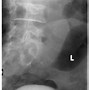 Image result for Bladder Tumor X-ray