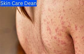 Image result for 10 Worst Skin Diseases