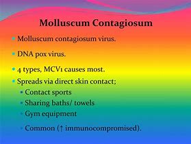 Image result for Deoxyribonucleic Acid Virus Molluscum Contagiosum