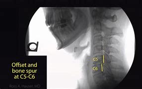 Image result for Cervical Spine Instability