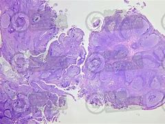 Image result for adenoloy�a