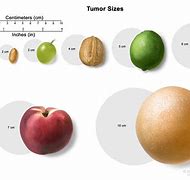 Image result for Tumor Size 1 Cm