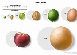 Image result for 8 Cm Tumor Size