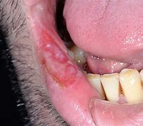Image result for Syphilis Tongue Sores