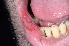Image result for Syphilis in Lips