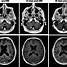 Image result for 2 Cm Brain Tumor