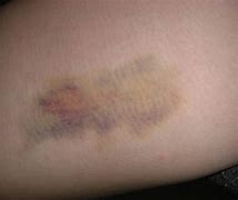 Image result for Bruise On My Thigh