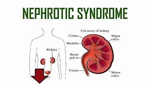 Image result for Nephritic Syndrome